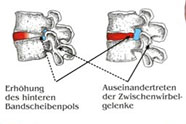 Spiralstabilisation der Wirbelsäule